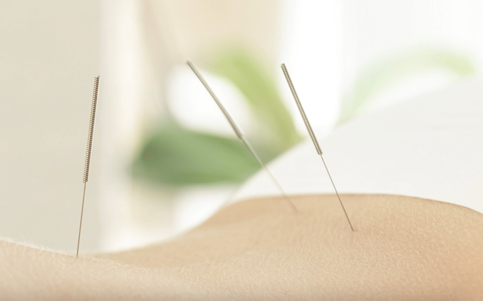 Acupuncture on back
